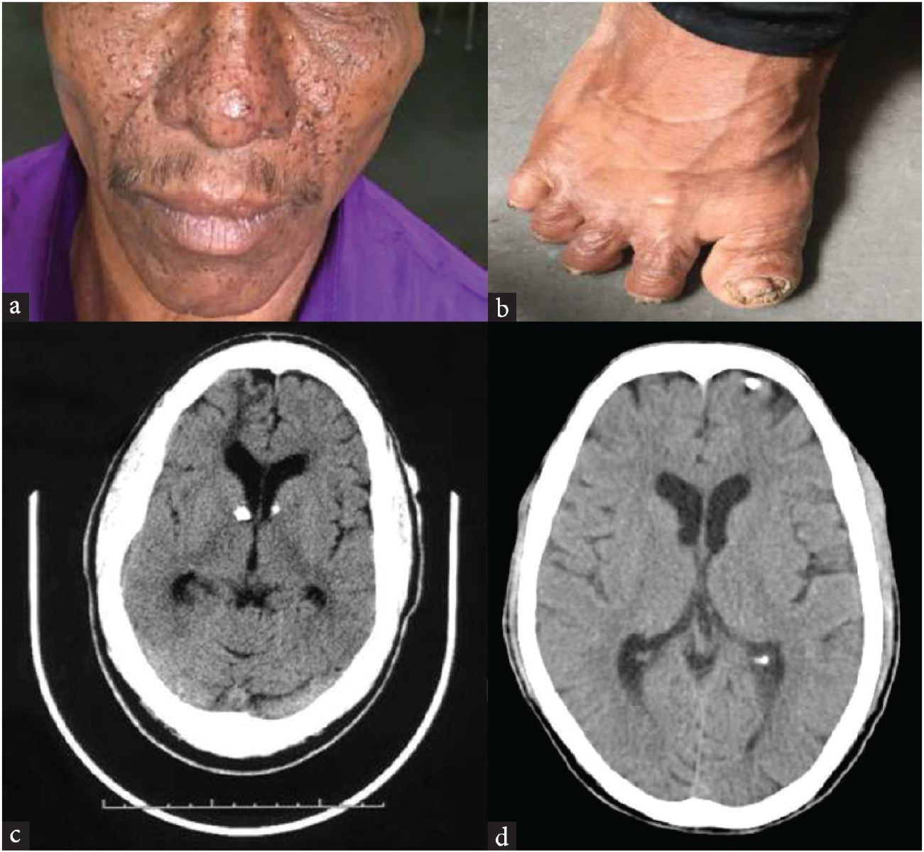 (a) Facial angiofibromas, (b) Koenen’s tumor over great toe, CT brain: (c) calcified subependymal nodules around lateral ventricles, and (d) subcortical calcifications.