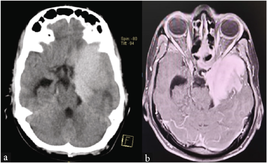 CT brain: (a) Skull base meningioma in the left temporal region, (b) skull base meningioma showing extension into the left sphenoid wing.