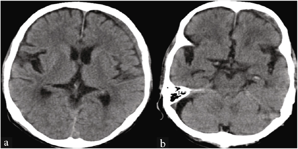 CT brain: (a) Subdural hemorrhage in the left cerebral convexity, (b) lacunar infarcts in the midbrain and pons.
